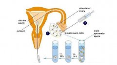 　美国试管婴儿中遇到卵巢储备不良怎么办？
