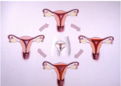 　美国试管婴儿中如何应对双子宫问题?